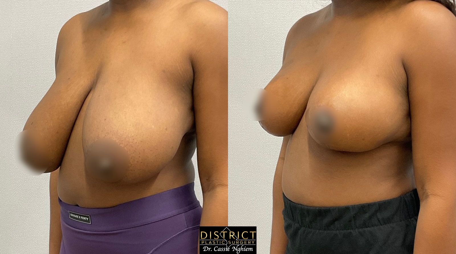 Breast Reduction Before and After Photo by District Plastic Surgery in Washington, DC