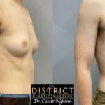 Double Incision Mastectomy Before and After Photo by District Plastic Surgery in Washington, DC