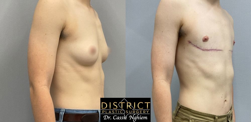 Double Incision Mastectomy Before and After Photo by District Plastic Surgery in Washington, DC