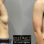 Double Incision Mastectomy Before and After Photo by District Plastic Surgery in Washington, DC