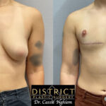 Double Incision Mastectomy Before and After Photo by District Plastic Surgery in Washington, DC