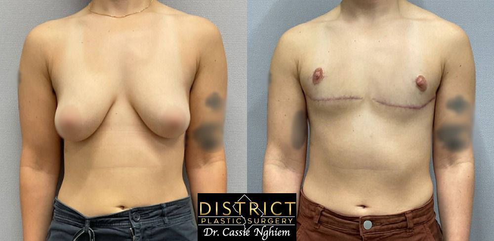 Double Incision Mastectomy Before and After Photo by District Plastic Surgery in Washington, DC