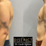 Double Incision Mastectomy Before and After Photo by District Plastic Surgery in Washington, DC