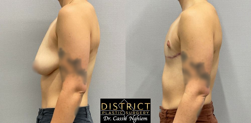 Double Incision Mastectomy Before and After Photo by District Plastic Surgery in Washington, DC