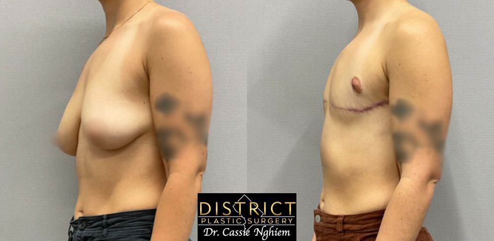 Double Incision Mastectomy Before and After Photo by District Plastic Surgery in Washington, DC