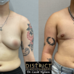 double incision mastectomy before and after