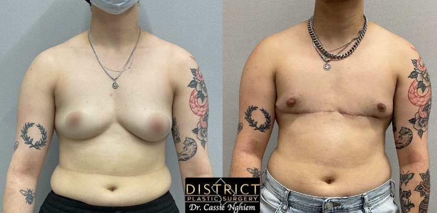 double incision mastectomy before and after