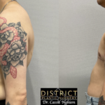 double incision mastectomy before and after