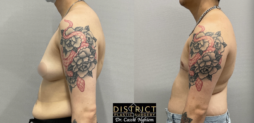 double incision mastectomy before and after