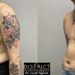 double incision mastectomy before and after