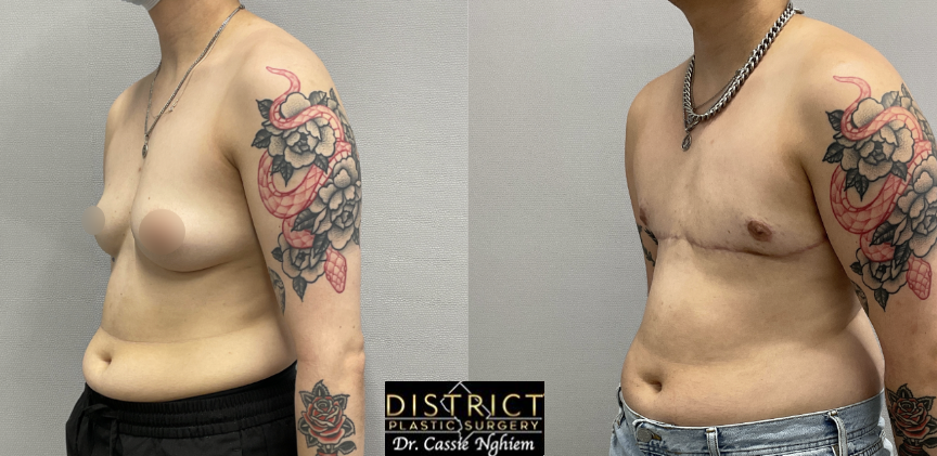 double incision mastectomy before and after