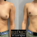 Double Incision Mastectomy Before and After Photo by District Plastic Surgery in Washington, DC