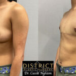 Double Incision Mastectomy Before and After Photo by District Plastic Surgery in Washington, DC