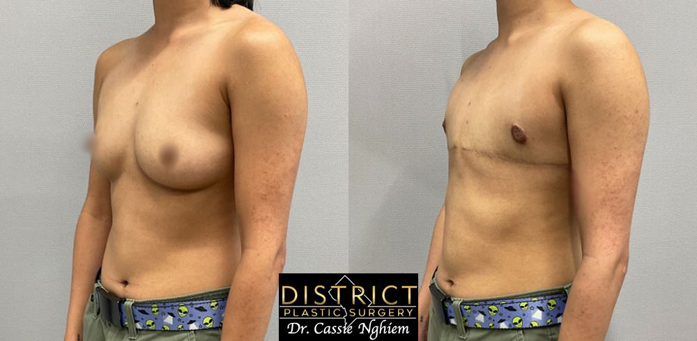 Double Incision Mastectomy Before and After Photo by District Plastic Surgery in Washington, DC