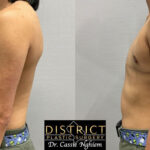 Double Incision Mastectomy Before and After Photo by District Plastic Surgery in Washington, DC