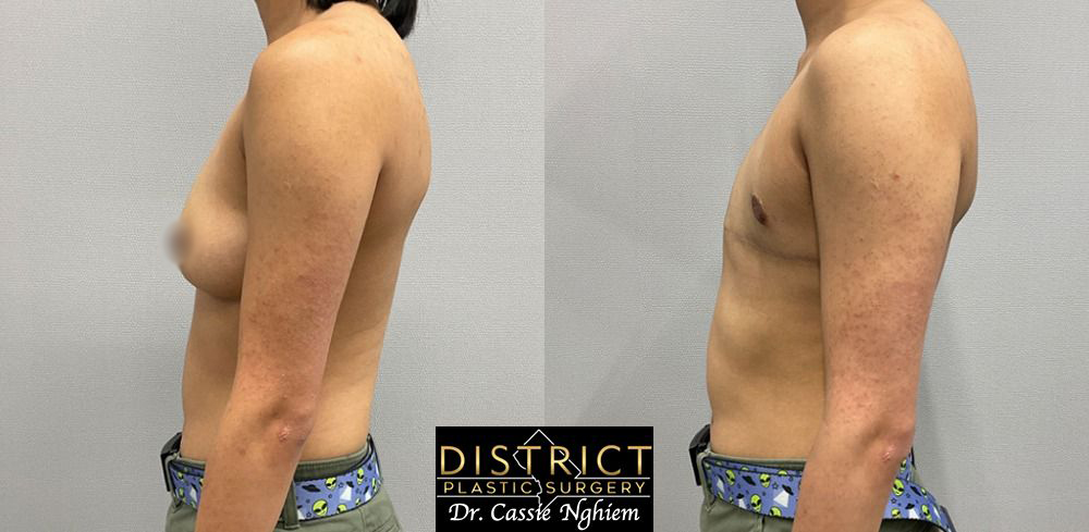 Double Incision Mastectomy Before and After Photo by District Plastic Surgery in Washington, DC