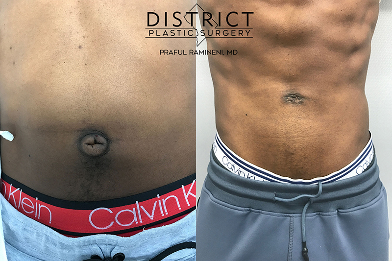 Belly Button Surgery Before and After Photo by District Plastic Surgery in Washington DC
