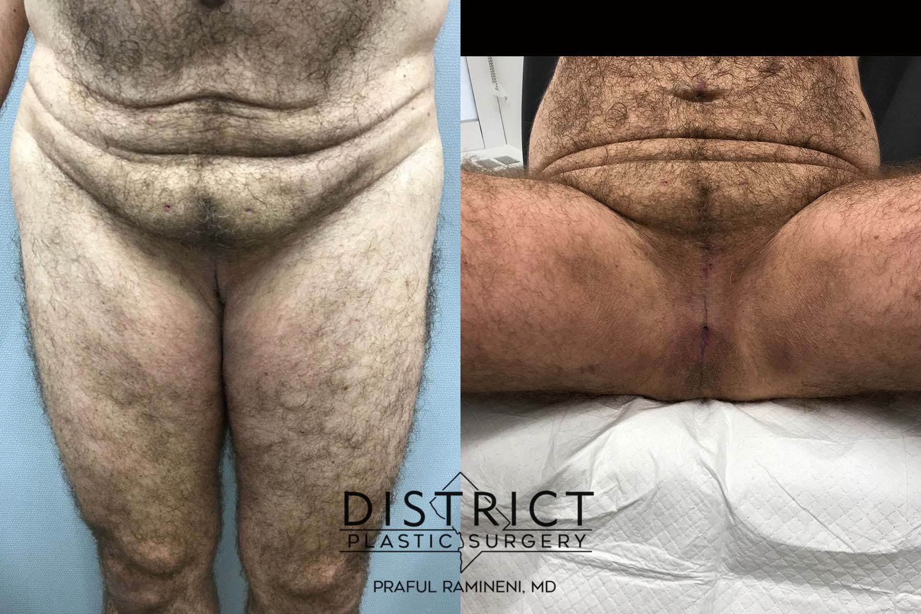 Gender Nullification Before and After Photo by District Plastic Surgery in Washington DC