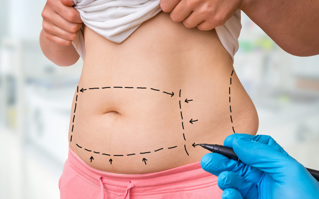 Combining Procedures: Is a Tummy Tuck Part of a Mommy Makeover? Client: District Plastic Surgery